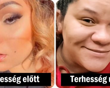 „2 különböző ember”: A 24 éves nőnek extrém „terhességi orra” van, és az emberek nem ismerik fel az arcát