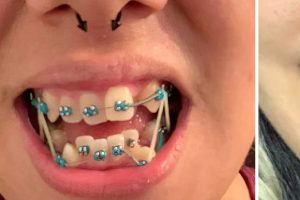 15 fotó, amely bizonyítja, hogy bárki fogai tökéletes mosollyá alakíthatók át