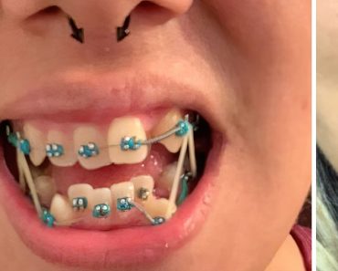15 fotó, amely bizonyítja, hogy bárki fogai tökéletes mosollyá alakíthatók át 15 fotó, amely bizonyítja, hogy bárki fogai tökéletes mosollyá alakíthatók át