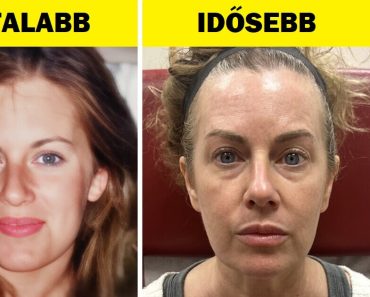 Egy nő botoxot használt, mert úgy akart kinézni, mint a fiatalabb énje, és az emberek szerint sikerült neki