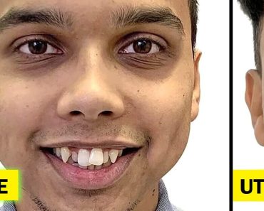 10+ ember, akik megtették a lépést a gyönyörű mosolyért, és soha nem bánták meg 10+ ember, akik megtették a lépést a gyönyörű mosolyért, és soha nem bánták meg