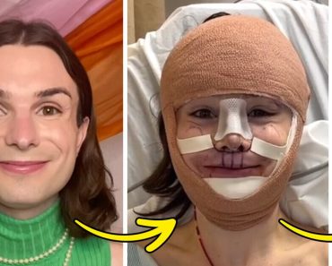 Dylan Mulvaney, a transznemű aktivista feltárja arcműtétjének őrült eredményeit